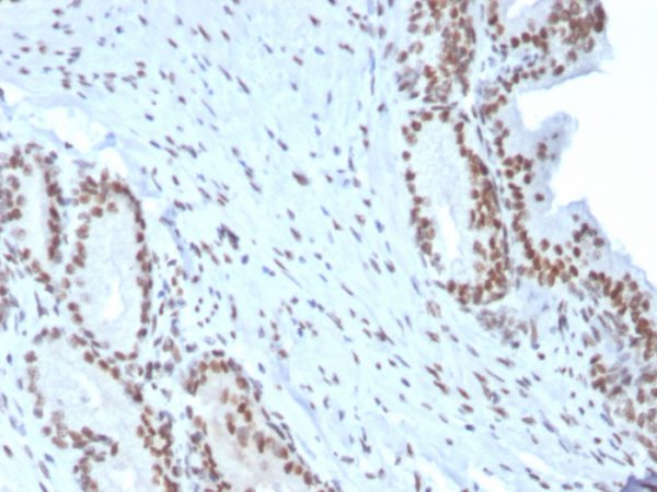 Formalin-fixed, paraffin-embedded human Prostate Carcinoma stained with BMI1 Mouse Monoclonal Antibody (BMI1/2823).