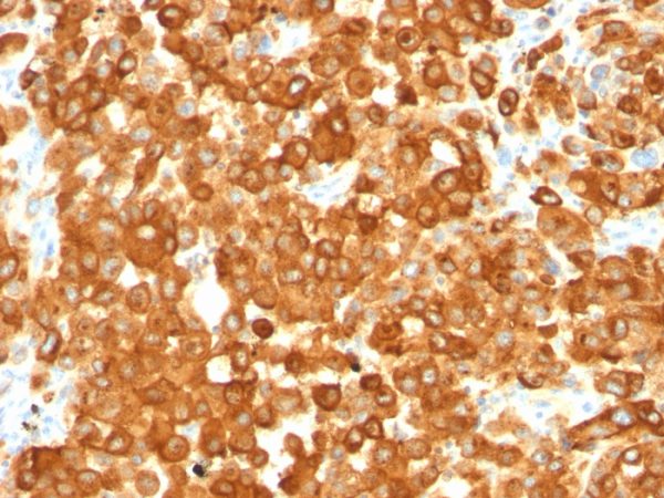 Formalin-fixed, paraffin-embedded human Melanoma stained with gp100 / Melanosome Monoclonal Antibody (HMB45).