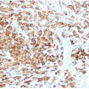 Formalin-fixed, paraffin-embedded human melanoma stained with gp100 Rabbit Recombinant Monoclonal Antibody (rPMEL17/6821).