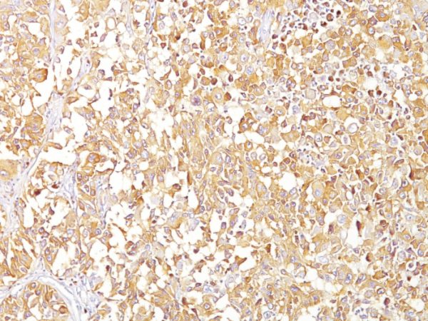 Formalin-fixed, paraffin-embedded human Melanoma stained with gp100 / Melanosome Monoclonal Antibody (SPM142).