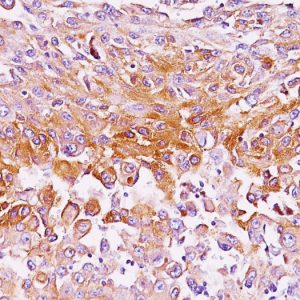 Formalin-fixed, paraffin-embedded human Melanoma stained with gp100 Monoclonal Antibody (SPM286).