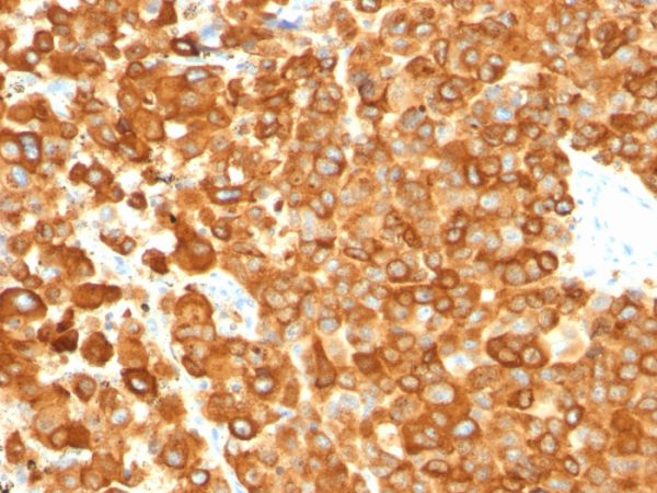 Formalin-fixed, paraffin-embedded human Melanoma stained with gp100 Mouse Monoclonal Antibody (PMEL/783).