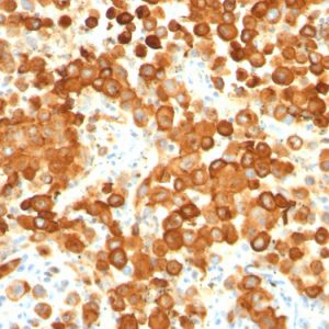 Formalin-fixed, paraffin-embedded human Melanoma stained with gp100 / Melanosome Monoclonal Antibody (HMB45 + PMEL/783).