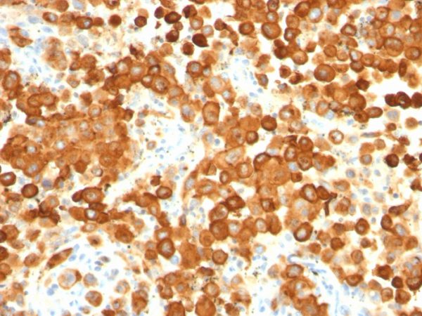 Formalin-fixed, paraffin-embedded human Melanoma stained with gp100 / Melanosome Monoclonal Antibody (HMB45 + PMEL/783).
