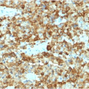 Formalin-fixed, paraffin-embedded human Melanoma stained with gp100 Mouse Monoclonal Antibody (PMEL/2037).