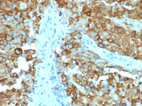 Formalin-fixed, paraffin-embedded human Melanoma stained with gp100 Mouse Monoclonal Antibody (PMEL/2038).