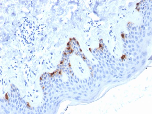 Formalin-fixed, paraffin-embedded human Skin stained with gp100 Mouse Monoclonal Antibody (PMEL/2038).