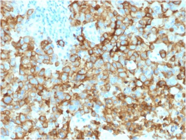 Formalin-fixed, paraffin-embedded human Melanoma stained with gp100 Mouse Monoclonal Antibody (PMEL/2039).