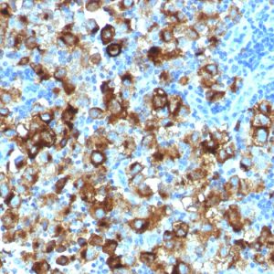 Formalin-fixed, paraffin-embedded human melanoma stained with gp100 Rabbit Recombinant Monoclonal Antibody (PMEL/1825R).