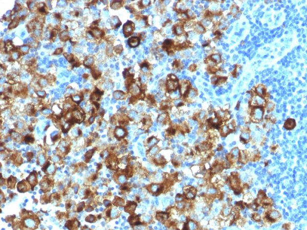 Formalin-fixed, paraffin-embedded human melanoma stained with gp100 Rabbit Recombinant Monoclonal Antibody (PMEL/1825R).