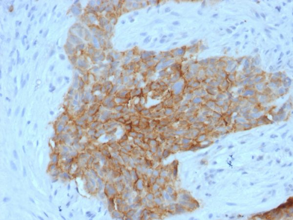 Formalin-fixed, paraffin-embedded human Tongue stained with GLUT-1 Mouse Monoclonal Antibody (GLUT1/2475).