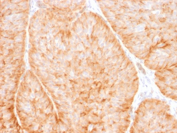 Formalin-fixed, paraffin-embedded human Bladder carcinoma stained withGLUT-1 Mouse Monoclonal Antibody (GLUT1/2475).