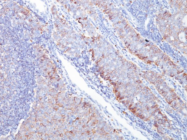 Formalin-fixed, paraffin-embedded human Breast Carcinoma stained with GLUT-1 Mouse Monoclonal Antibody (GLUT1/2476).