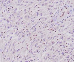 Formalin-fixed, paraffin-embedded human epithelioid sarcoma stained with INI-1 Recombinant Mouse Monoclonal Antibody (rSMARCB1/4588). Note loss of nuclear expression in tumor cells and retained positivity in normal cells.