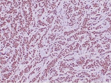 Formalin-fixed, paraffin-embedded human sarcoma stained with INI-1 Recombinant Rabbit Monoclonal Antibody (SMARCB1/4587R) HIER: Tris/EDTA, pH9.0, 45min. 2°C: HRP-polymer, 30min. DAB, 5min. Recombinant Integrase interactor 1 (INI-1) / SNF5 / SMARCB1 Antibody