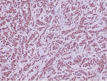 Formalin-fixed, paraffin-embedded human sarcoma stained with INI-1 Recombinant Rabbit Monoclonal Antibody (SMARCB1/4587R) HIER: Tris/EDTA, pH9.0, 45min. 2°C: HRP-polymer, 30min. DAB, 5min.
