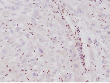 Formalin-fixed, paraffin-embedded human epithelioid sarcoma stained with INI-1 Recombinant Rabbit Monoclonal Antibody (SMARCB1/4587R). HIER: Tris/EDTA, pH9.0, 45min. 2°C: HRP-polymer, 30min. DAB, 5min.