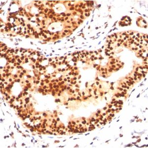 Formalin-fixed, paraffin-embedded human Breast Carcinoma stained with SUMO-2/3 Mouse Monoclonal Antibody (SM23/496)