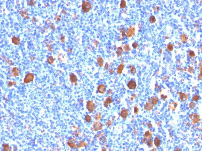 Formalin-fixed, paraffin-embedded human Hodgkin's Lymphoma stained with Fascin-1 Mouse Monoclonal Antibody (FSCN1/416). Fascin-1 (Reed-Sternberg Cell Marker) Antibody