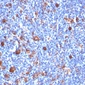 Formalin-fixed, paraffin-embedded human Hodgkin&apos;s Lymph stained with Fascin-1 Mouse Monoclonal Antibody (SPM133)