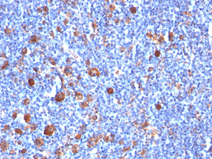 Formalin-fixed, paraffin-embedded human Hodgkin's Lymph stained with Fascin-1 Mouse Monoclonal Antibody (SPM133) Fascin-1 (Reed-Sternberg Cell Marker) Antibody