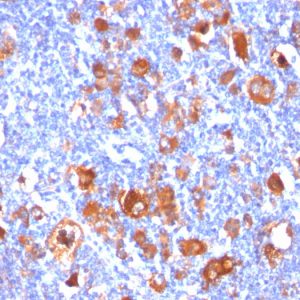 Formalin-fixed, paraffin-embedded human Hodgkin&apos;s Lymphoma stained with Fascin-1 Mouse Monoclonal Antibody (FSCN1/418).
