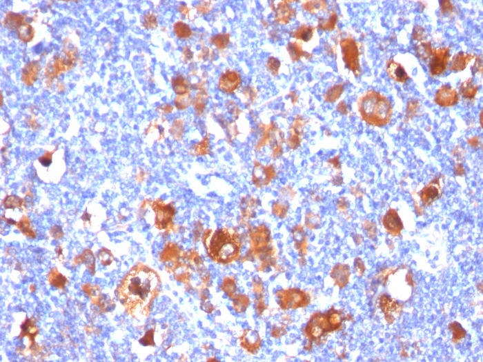Formalin-fixed, paraffin-embedded human Hodgkin's Lymphoma stained with Fascin-1 Mouse Monoclonal Antibody (FSCN1/418). Fascin-1 (Reed-Sternberg Cell Marker) Antibody