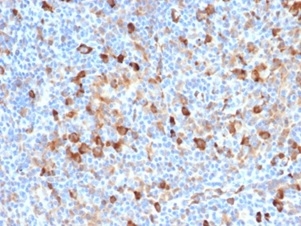 IHC analysis of formalin-fixed, paraffin-embedded human Hodgkin&apos;s lymphoma.  Cytoplasmic staining using FSCN1/7209 at 2ug/ml in PBS for 30min RT. HIER: Tris/EDTA, pH9.0, 45min. 2°C: HRP-polymer, 30min. DAB, 5min.