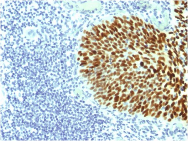 Formalin-fixed, paraffin-embedded human Cervical Carcinoma stained with SOX2 Mouse Monoclonal Antibody (SOX2/1791).
