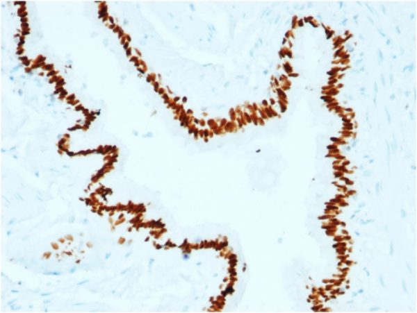 Formalin-fixed, paraffin-embedded human Lung Carcinoma stained with SOX2 Mouse Monoclonal Antibody (SOX2/1791).