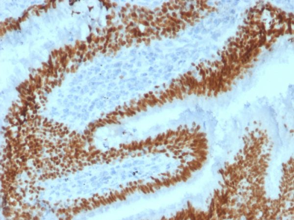 Formalin-fixed, paraffin-embedded human Lung Carcinoma stained with SOX2 Mouse Monoclonal Antibody (SOX2/1792).