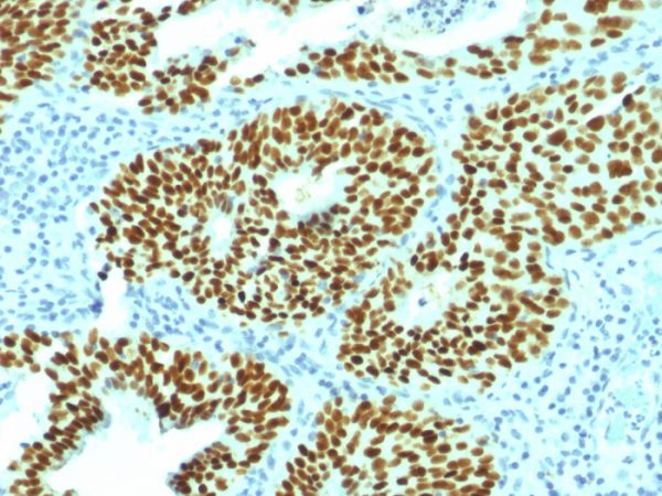 Formalin-fixed, paraffin-embedded human Cervical Carcinoma stained with SOX2 Mouse Monoclonal Antibody (SOX2/1792).