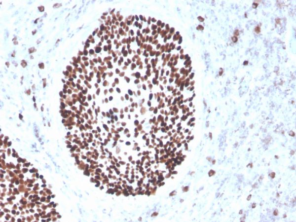 Formalin-fixed, paraffin-embedded human cervix stained with SOX2 Recombinant Mouse Monoclonal Antibody (rSOX2/1791).