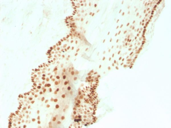 Formalin-fixed, paraffin-embedded human cervical carcinoma stained with SOX2 Recombinant Rabbit Monoclonal Antibody (SOX2/3811R).