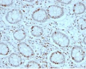 Formalin-fixed, paraffin-embedded human colon carcinoma stained with SOX4 Mouse Monoclonal Antibody (PCRP-SOX4-1D6). HIER: Tris/EDTA, pH9.0, 45min. 2 °: HRP-polymer, 30min. DAB, 5min.
