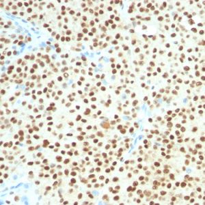 Formalin-fixed, paraffin-embedded human melanoma stained with SOX10 Mouse Monoclonal Antibody (SOX10/1074).