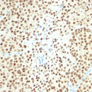 Formalin-fixed, paraffin-embedded human Melanoma stained with SOX10 Monoclonal Antibody (SPM607).