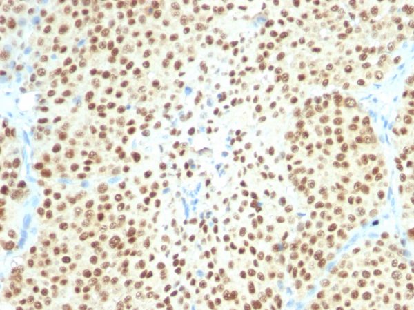 Formalin-fixed, paraffin-embedded human Melanoma stained with SOX10 Monoclonal Antibody (SPM607).