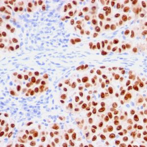 Formalin-fixed, paraffin-embedded human melanoma stained with SOX10-Monospecific Recombinant Mouse Monoclonal Antibody (rSOX10/1074).