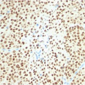 Formalin-fixed, paraffin-embedded human Melanoma stained with SOX10-Monospecific Recombinant Rabbit Monoclonal Antibody (SOX10/2311R).
