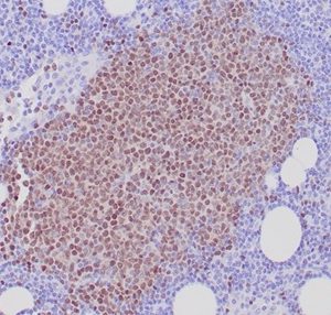 Formalin-fixed, paraffin-embedded human mantle cell lymphoma stained with SOX11 Mouse Monoclonal Antibody (SOX11/7236). HIER: Tris/EDTA, pH9.0, 45min. 2°C: HRP-polymer, 30min. DAB, 5min.
