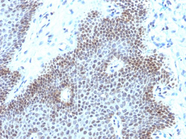Formalin-fixed, paraffin-embedded human cervical carcinoma stained with SOX11 Recombinant Rabbit Monoclonal Antibody (SOX11/3235R).