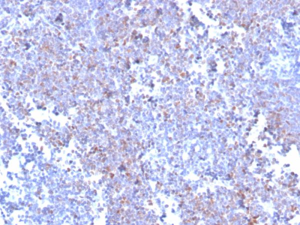 Formalin-fixed, paraffin-embedded human mantle cell lymphoma stained with SOX11 Recombinant Rabbit Monoclonal Antibody (SOX11/3235R).