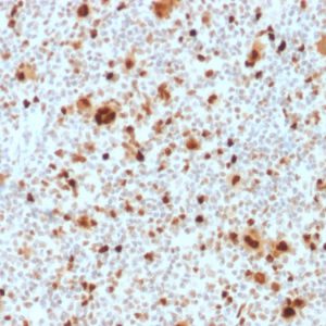 Formalin-fixed, paraffin-embedded human Hodgkin&apos;s Lymphoma stained with PU.1 Mouse Monoclonal Antibody (PU1/2118).