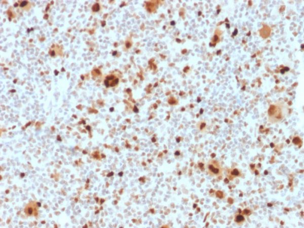 Formalin-fixed, paraffin-embedded human Hodgkin&apos;s Lymphoma stained with PU.1 Mouse Monoclonal Antibody (PU1/2118).