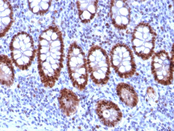 Formalin-fixed, paraffin-embedded human Colon Carcinoma stained with PU.1 Mouse Monoclonal Antibody (PU1/2118).