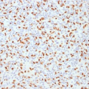 Formalin-fixed, paraffin-embedded human Hodgkin&apos;s Lymphoma stained with PU.1-Monospecific Mouse Monoclonal Antibody (PU1/2146).