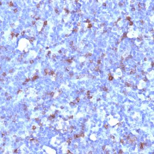 Formalin-fixed, paraffin-embedded human Lymphoma stained with CD43 Mouse Monoclonal Antibody (SPN/1094).