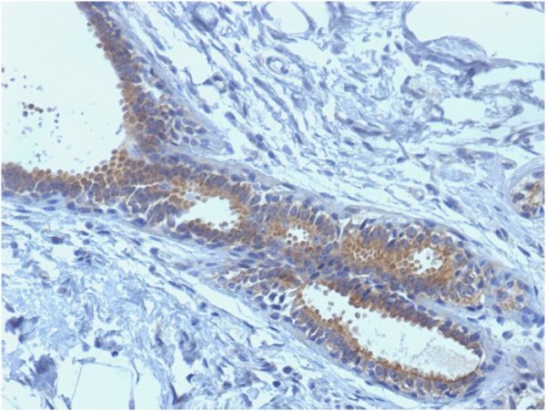 Formalin-fixed, paraffin-embedded human Breast Carcinoma stained with BRCA1 Mouse Monoclonal Antibody (BRCA1/1398).