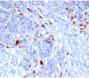 IHC analysis of formalin-fixed, paraffin-embedded human ovarian carcinoma. SREBP1 Mouse Monoclonal Antibody (SREBP1/1578) at 2ug/ml. Inset: PBS instead of primary antibody; secondary only negative control.